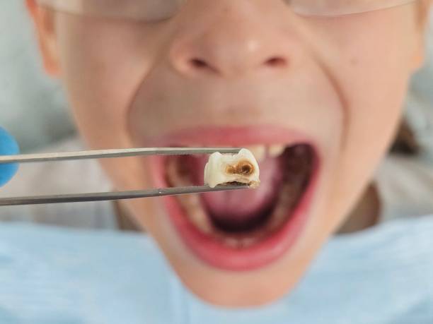 Best Emergency Treatment for Dental Infections or Abscesses in Nahunta, GA